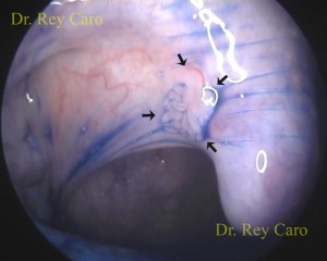 Verruga de HPV claramente visualizada luego de la tinción