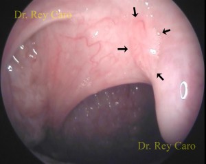 Lesión plana en paladar blando derecho próxima a la úvula
