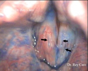 Cromoendoscopía en consultorio. Luego de la instilación en cuerdas vocales del Indigo Carmín (bajo anestesia local de la laringe) es posible observar surcos en ambas cuerdas vocales.