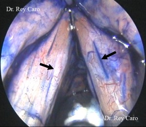 Cromoscopía con anestesia general. El Indigo Carmin se deposita en las irregularidades de la cubierta mucosa permitiéndo observar el sitio del puente mucoso.
