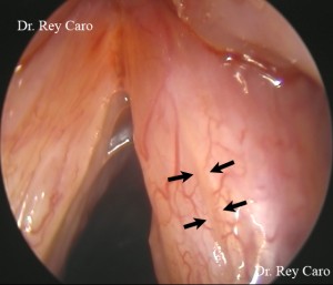 Surco en cara superior de cuerda vocal derecha correspondiente a un puente mucoso (flechas). Sin Cromoscopia 