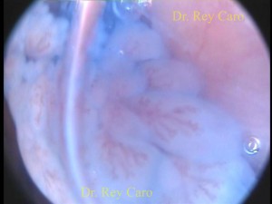 Otra visión magnificada por casi contacto del endoscopio con la lesión