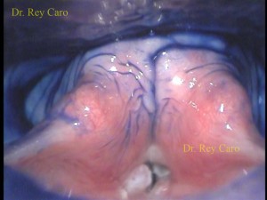 Cromoendoscopia de boca de esófago 