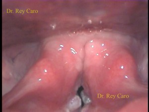 Imágen de boca de esófago en un paciente con HPV de laringe