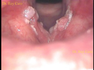 Papilomatosis laríngea severa que compromete ambas cuerdas vocales, ventrículos y comisura anterior
