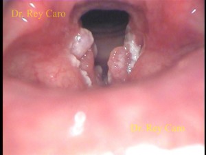 Foto 6b. Papilomatosis laríngea severa. Se observa un edema moderado en la región interaritenoidea