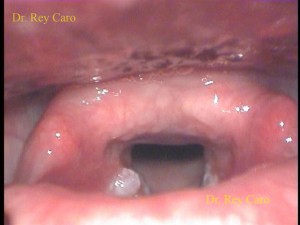 Vista panorámica de boca de esófago y región posterior de laringe