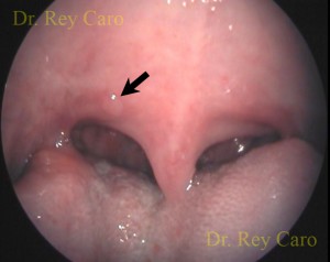 Foto 5a. Lesión sobreelevada sospechosa de HPV en paladar blando. 