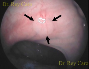 Foto 5b. Con cromoendoscopía y magnificación puede observarse el eje conectivo vascular característico de la verruga por HPV